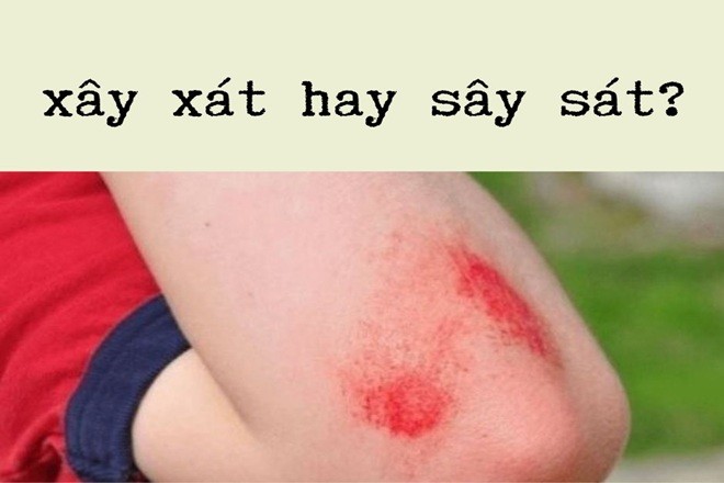 Bàn tay bị trầy xước nhẹ do va chạm
